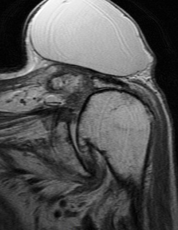 Figure 2 for case Large cyst above a degenerated acromioclavicular joint ( RID1895 )